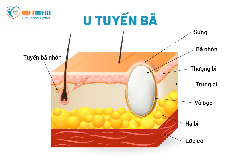 U bã đậu - Phòng Khám VIETMEDI