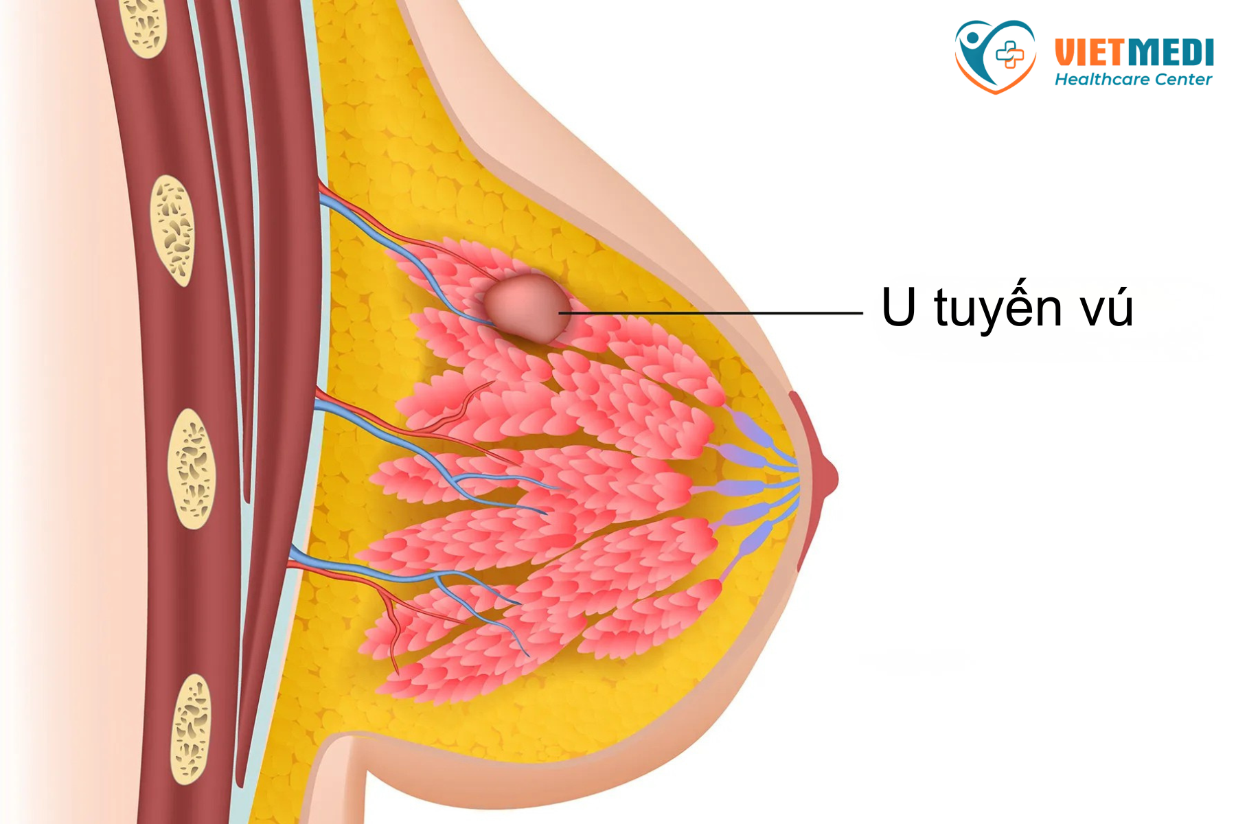 U tuyến vú