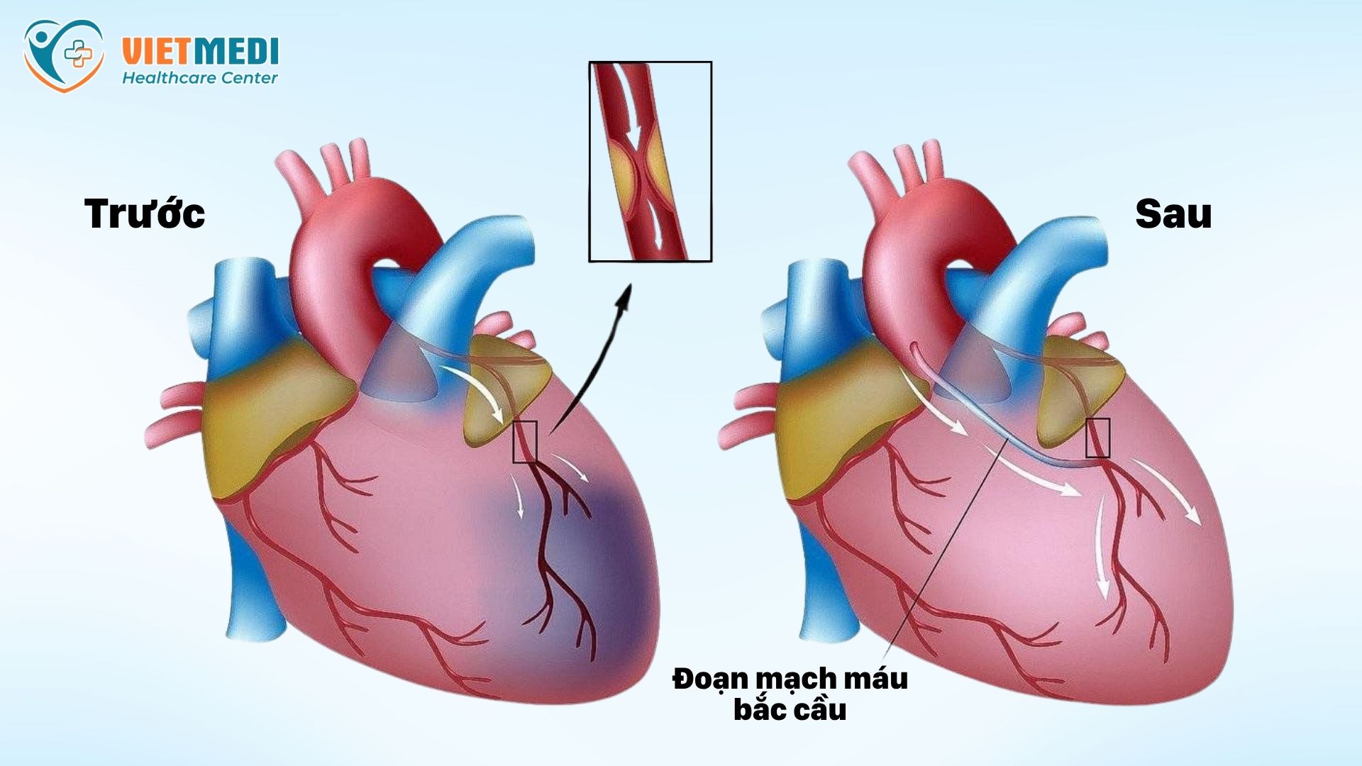 benh-mach-vanh-3