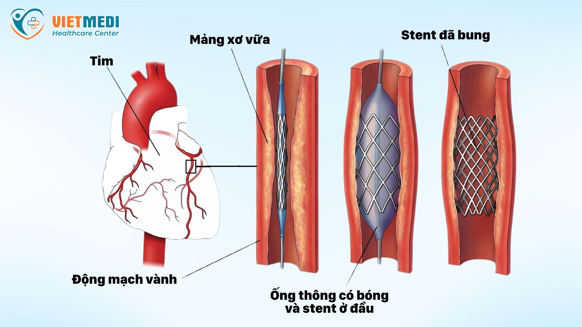 benh-mach-vanh-4