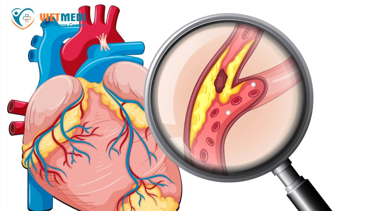 cach-phong-ngua-dot-quy-1