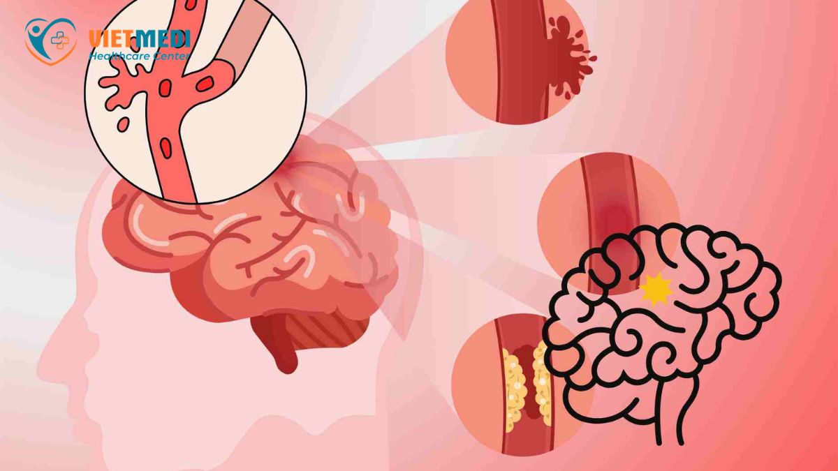 nguyen-nhan-gay-dot-quy-3