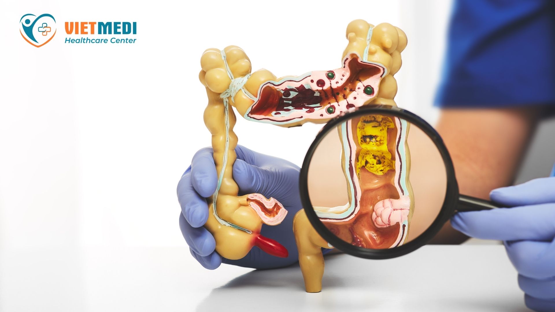 polyp-dai-trang-1