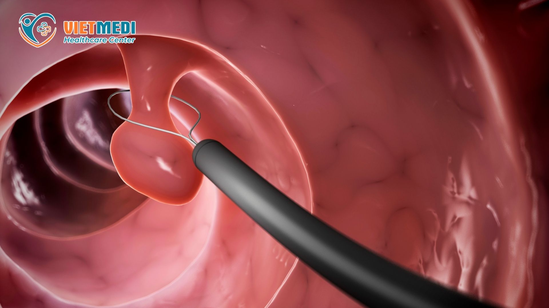 polyp-dai-trang-2