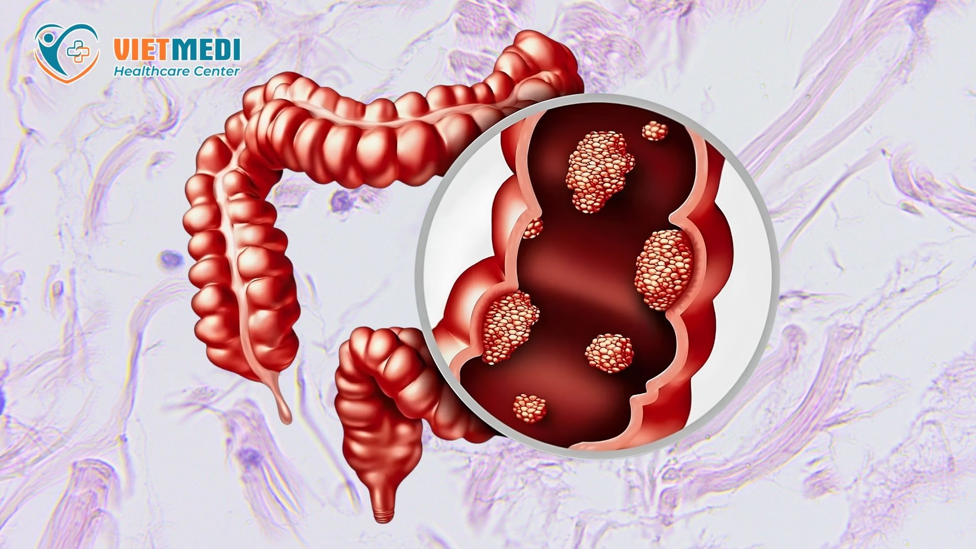polyp-dai-trang-3
