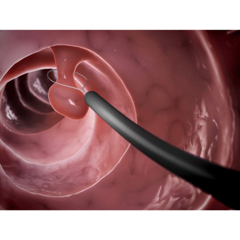 polyp đại tràng