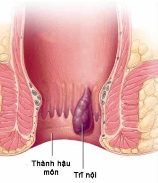 trĩ dài