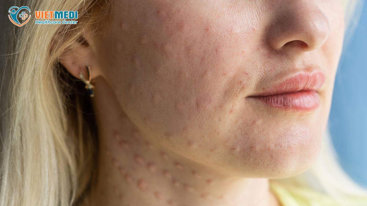 u-hat-sau-tiem-meso-2