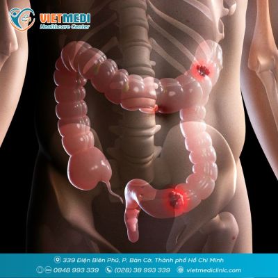 V&Igrave; SAO NỘI SOI C&Oacute; THỂ PH&Aacute;T HIỆN UNG THƯ ĐẠI TR&Agrave;NG TỪ KHI CHƯA C&Oacute; TRIỆU CHỨNG?
