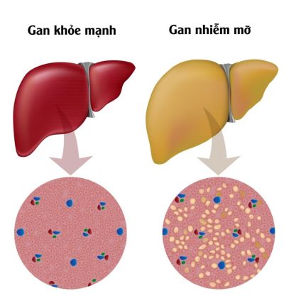 GAN NHIỄM MỠ LÀ GÌ? NGUYÊN NHÂN, TRIỆU CHỨNG VÀ CÁCH PHÒNG NGỪA HIỆU QUẢ