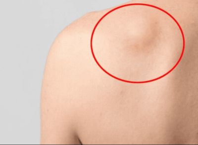 BƯỚU MỠ LÀ GÌ? DẤU HIỆU, NGUYÊN NHÂN VÀ CÁCH XỬ LÝ HIỆU QUẢ