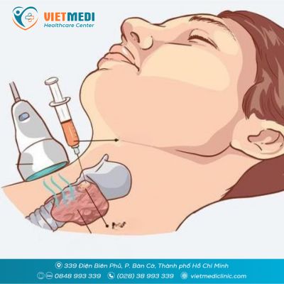 CHỌC H&Uacute;T TẾ B&Agrave;O BẰNG KIM NHỎ (FNA) - &Yacute; NGHĨA TRONG CHẨN ĐO&Aacute;N UNG THƯ