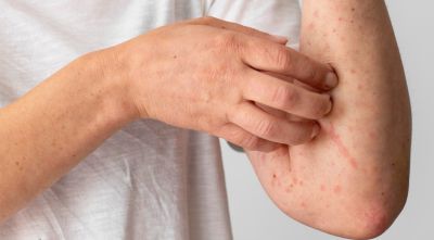 VIÊM DA CƠ ĐỊA: NGUYÊN NHÂN, TRIỆU CHỨNG, BIẾN CHỨNG VÀ CÁCH PHÒNG NGỪA