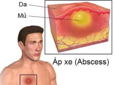 ÁP XE PHẦN MỀM DƯỚI DA: DẤU HIỆU, NGUY CƠ VÀ CÁCH ĐIỀU TRỊ HIỆU QUẢ