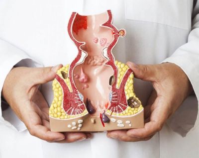 THẮT BÚI TRĨ BẰNG VÒNG CAO SU: PHƯƠNG PHÁP ĐƠN GIẢN, ÍT ĐAU, HIỆU QUẢ CAO
