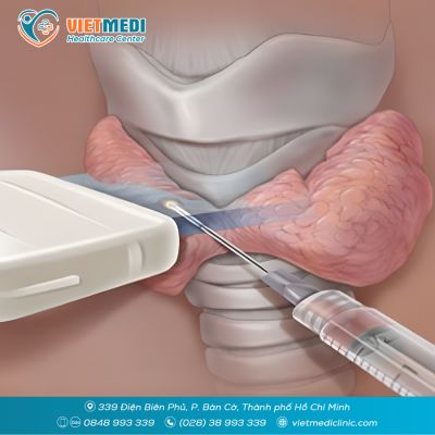 ỨNG DỤNG ĐỐT S&Oacute;NG CAO TẦN (RFA) TRONG ĐIỀU TRỊ KHỐI U